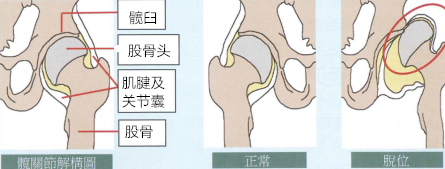 【育儿贴士】发展性髋关节发育不良